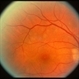 color fundus photo showing multifocal choroiditis